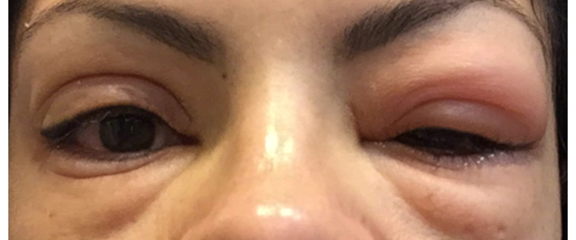 Can eyelash extensions give you an eye infection?