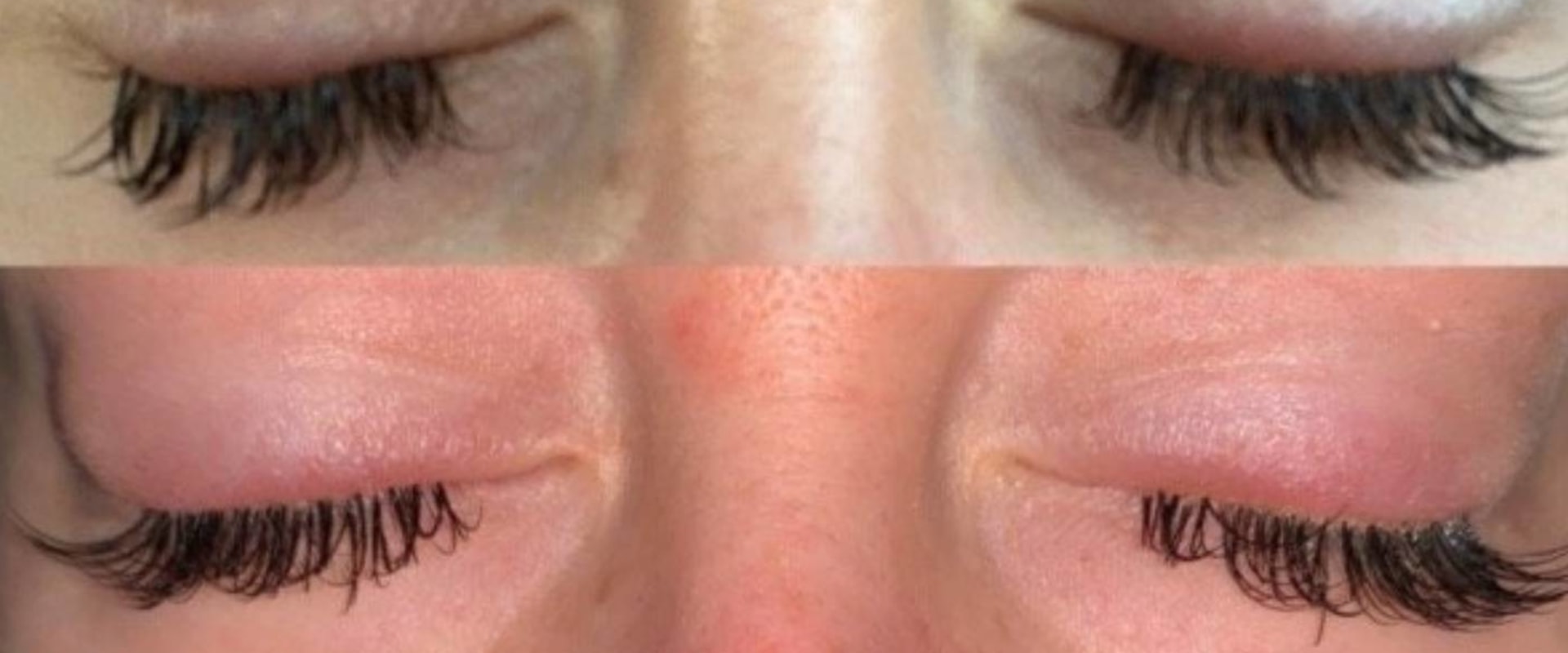 Can eyelash glue cause swollen eyelids?