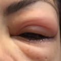 Can eyelash extensions give you an eye infection?