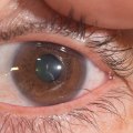 What happens to eyelash under eyelid?