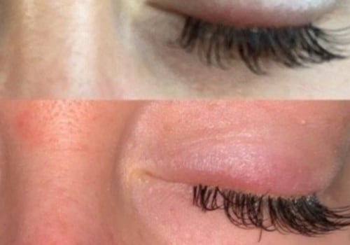 Can lash extensions cause eye problems?