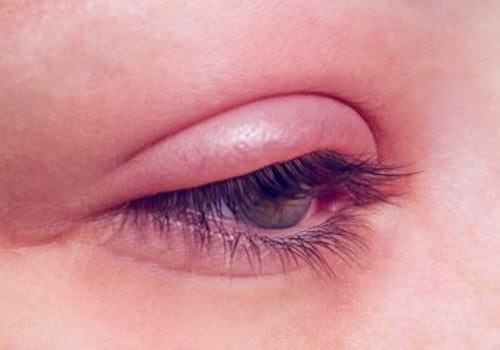What happens if you have an allergic reaction to eyelash extensions?
