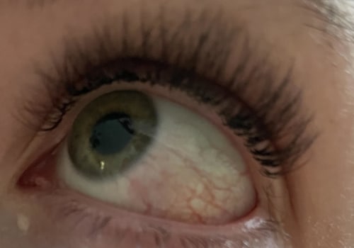 How long do eyes burn after eyelash extensions?