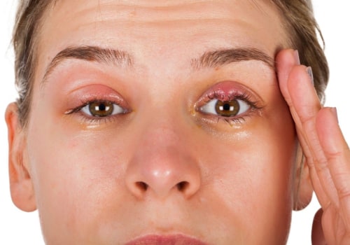 Can eyelash extension cause stye?